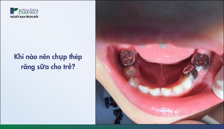 Chụp thép răng sữa ở trẻ em