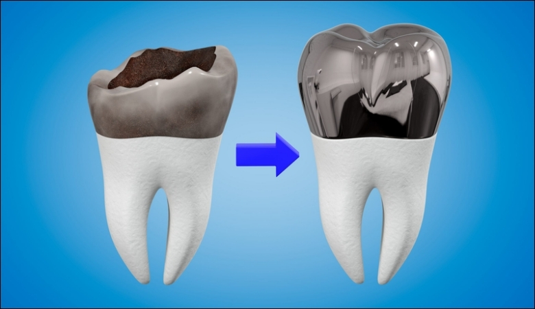 Chụp thép răng sữa là gì?