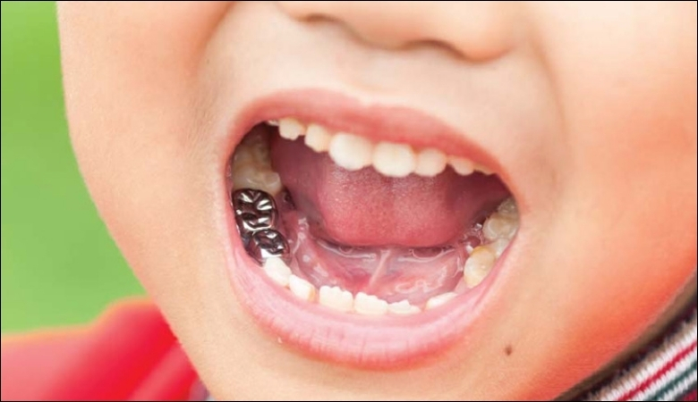 Lý do nên chụp thép răng cho trẻ