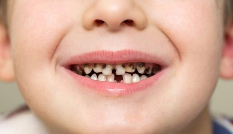 Chụp thép khi răng sữa bị sâu vỡ lớn