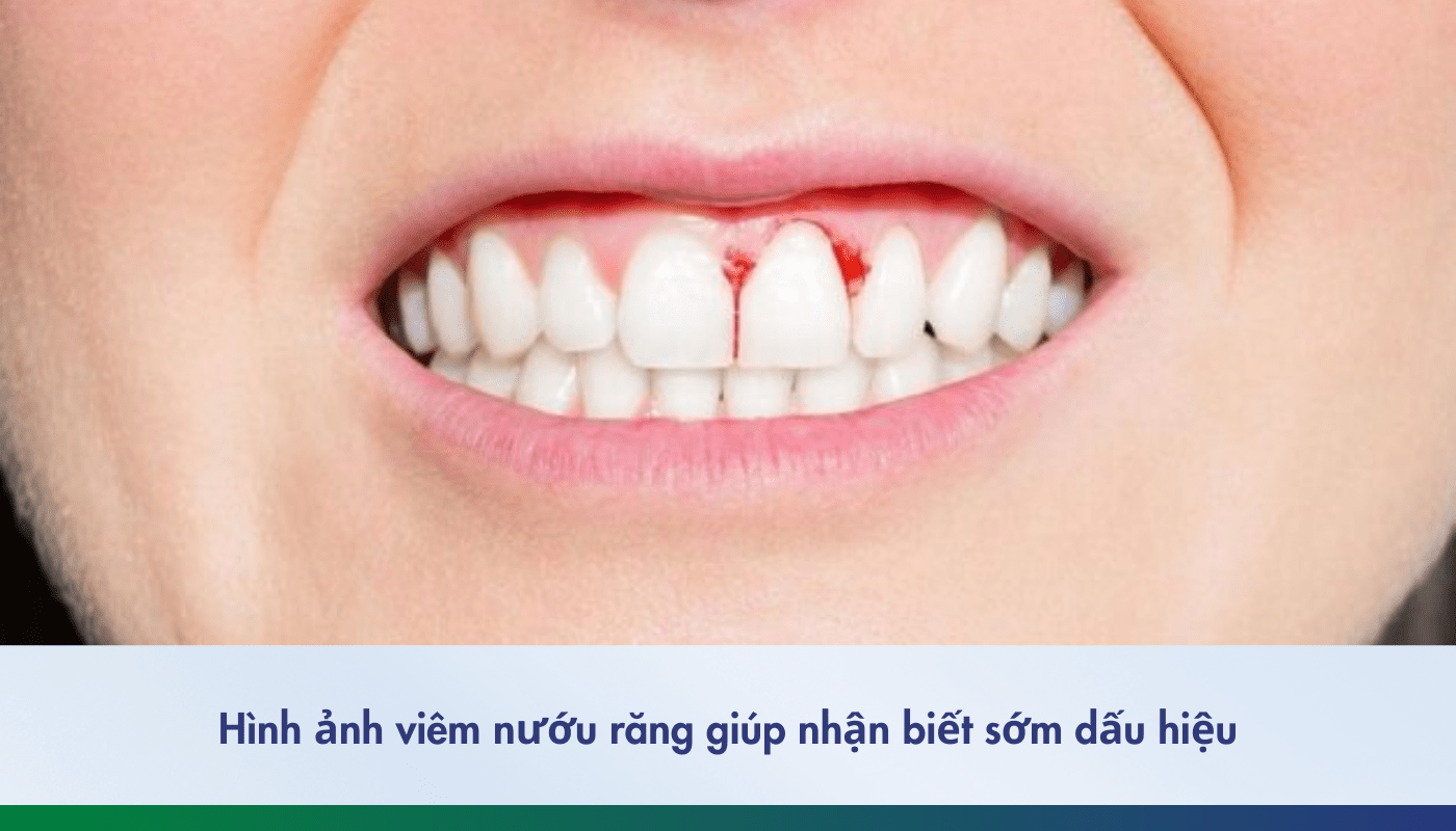Hình ảnh viêm nướu răng giúp nhận biết sớm các dấu hiệu
