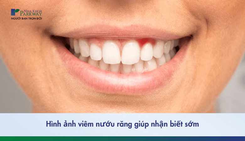 hình ảnh viêm nướu răng và cách khắc phục