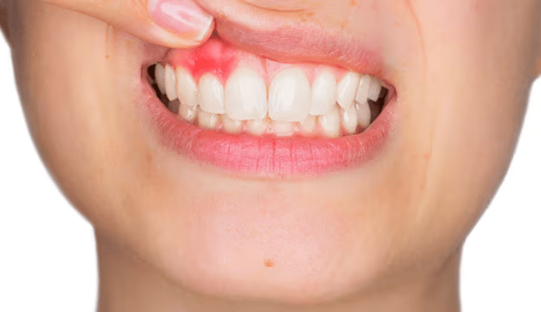 viêm nướu răng là triệu chứng gì