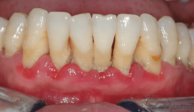 Hình ảnh viêm nướu răng - 1