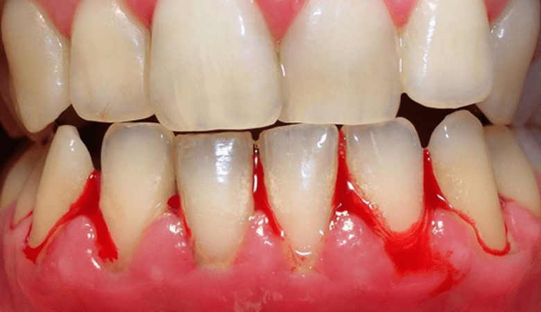 Hình ảnh viêm nướu răng - 2