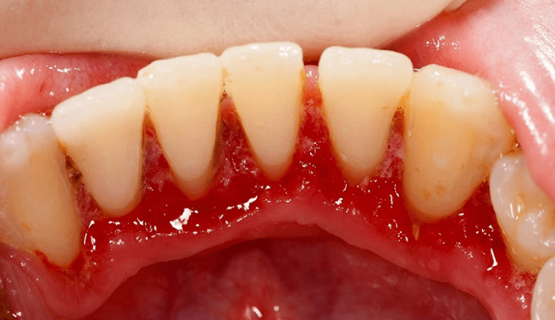Hình ảnh viêm nướu răng - 3