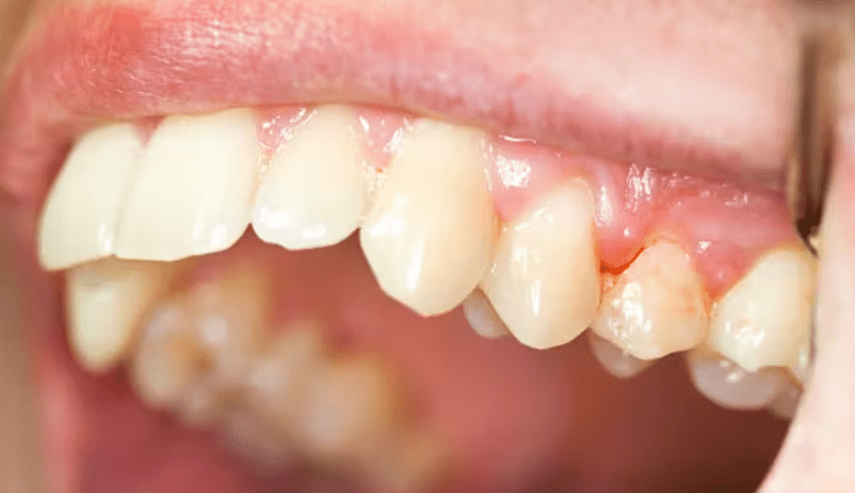 Hình ảnh viêm nướu răng - 4