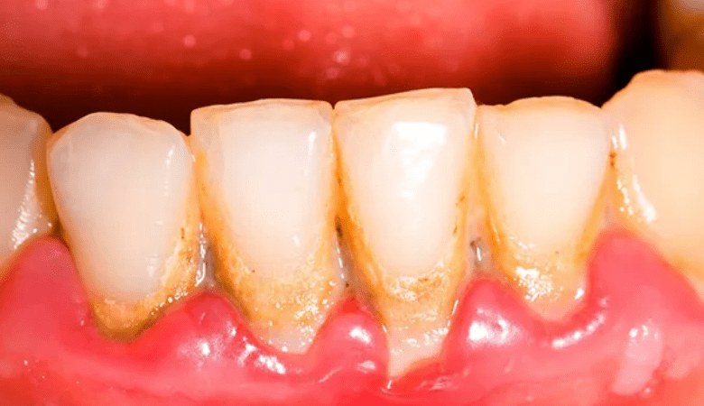 Hình ảnh viêm nướu răng - 5