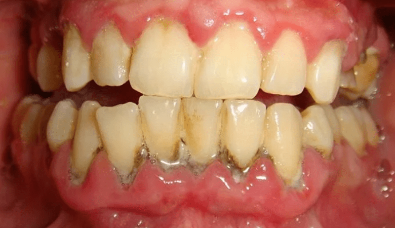 Hình ảnh viêm nướu răng - 6