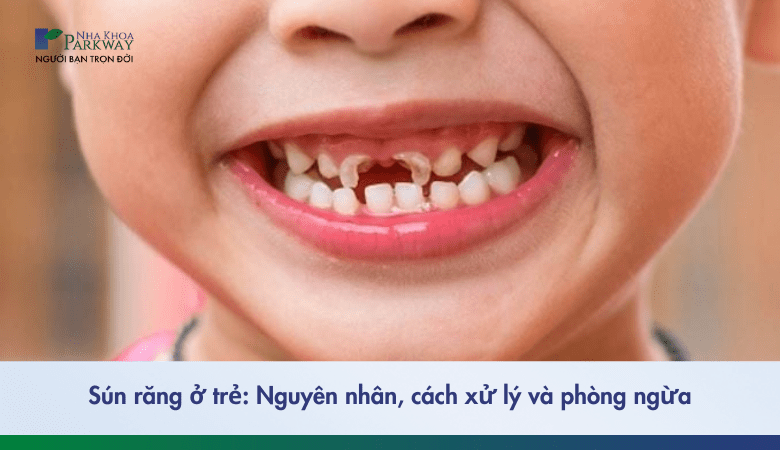 Sún răng ở trẻ bởi nguyên nhân gì