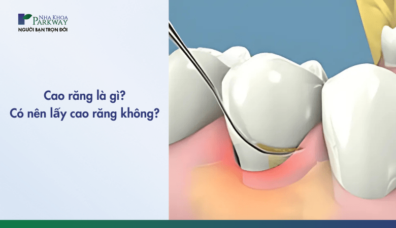Cao răng là gì - khi nào lấy cao răng