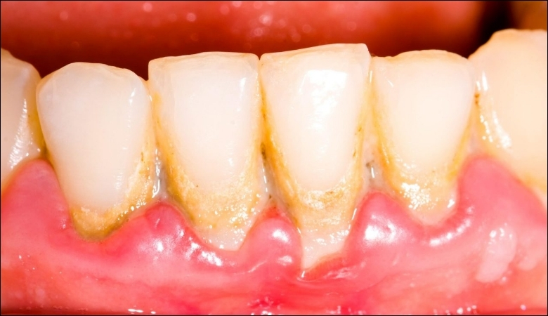 Tình trạng mòn men răng