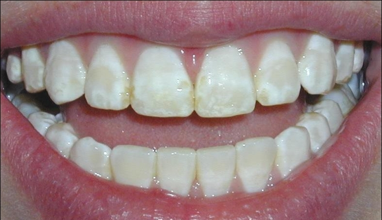 Tình trạng thiếu sản men răng