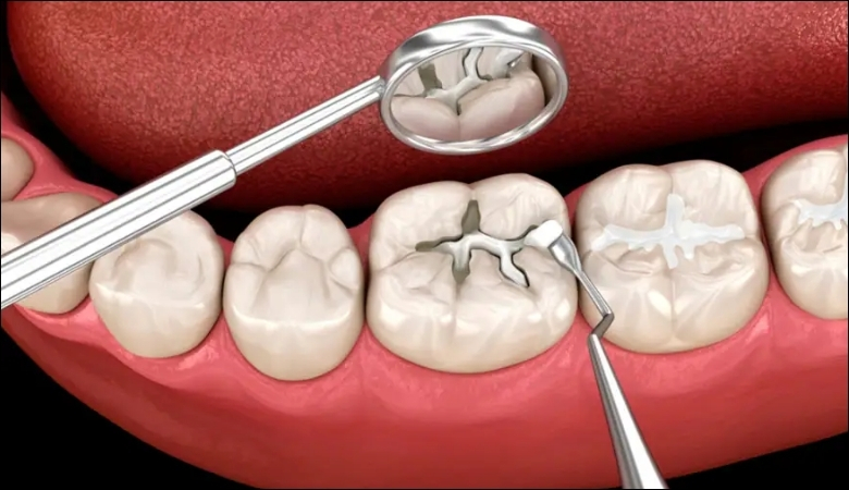 Trám răng khi lớp men răng bị hư hại nghiêm trọng để ngừa sâu răng