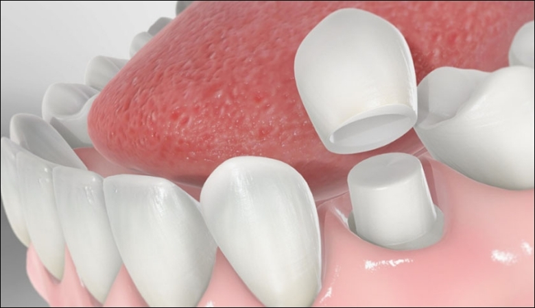 Bọc sứ giúp phục hồi men răng hư tổn và đem lại hàm răng đều đẹp