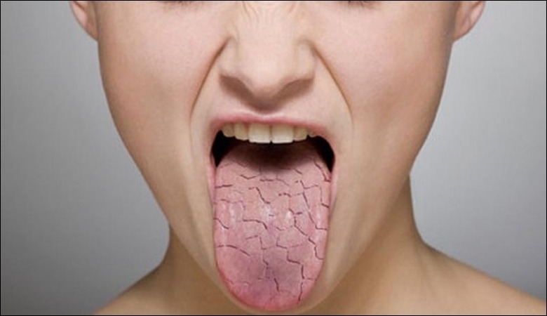 Khô miệng có thể gây nên tình trạng đắng miệng