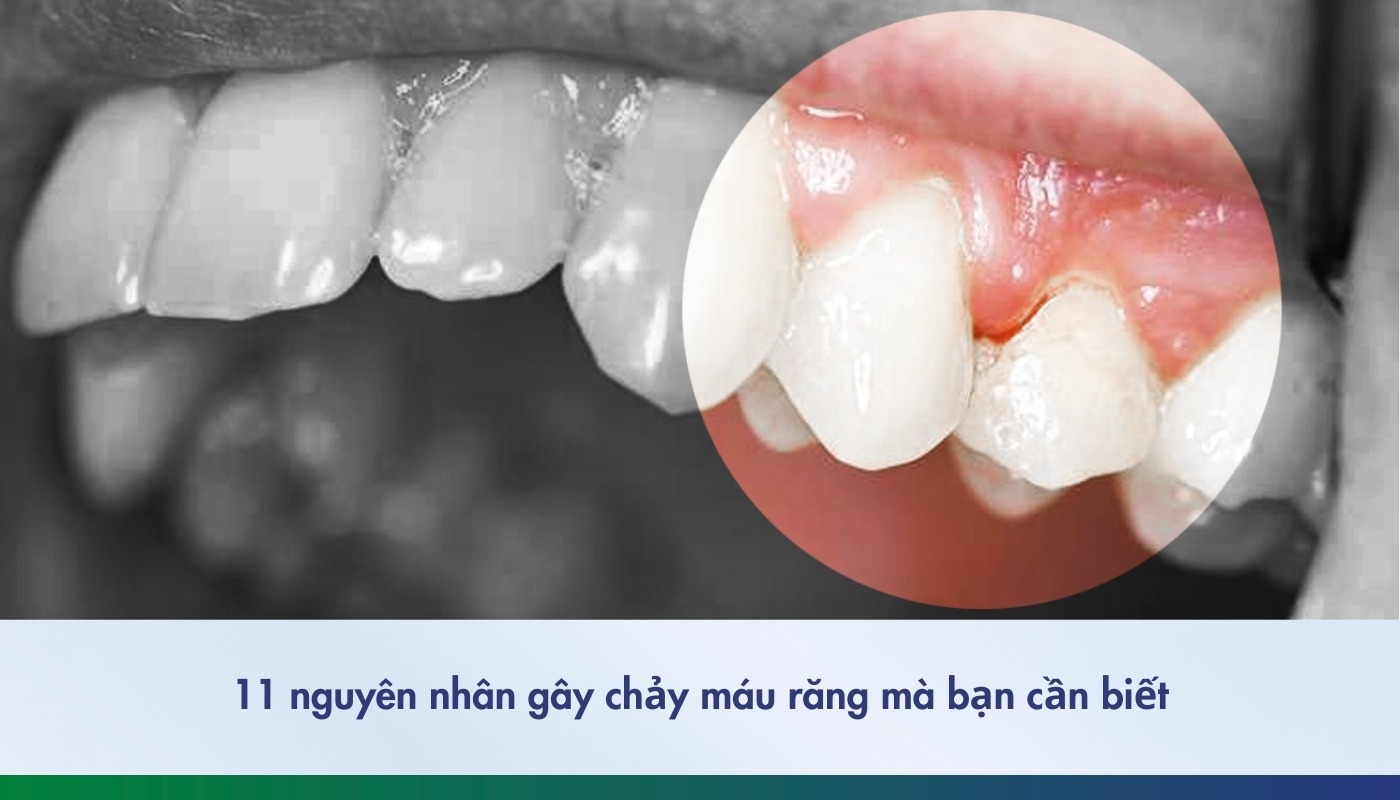 11 nguyên nhân gây chảy máu răng