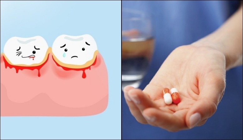 Sử dụng thuốc chống đông máu có thể dễ gây chảy máu răng