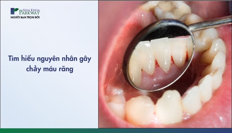 Tìm hiểu các nguyên nhân gây chảy máu răng