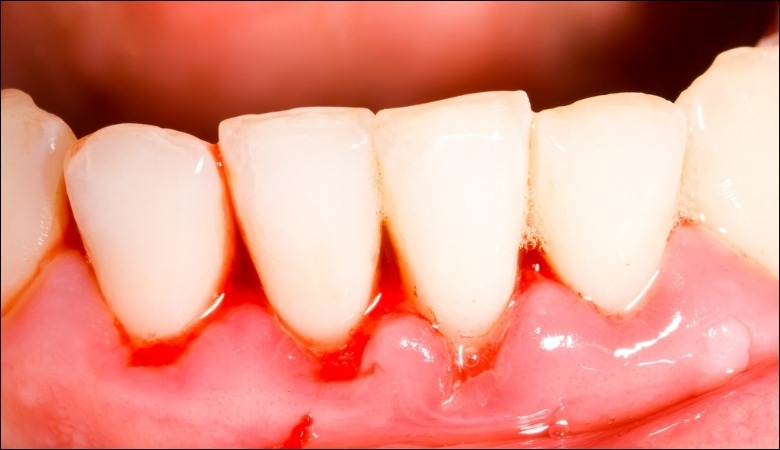 Chảy máu răng còn là dấu hiệu của một số bệnh nha chu