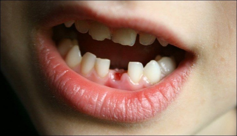 Chân thương gây chảy máu hoặc gãy răng