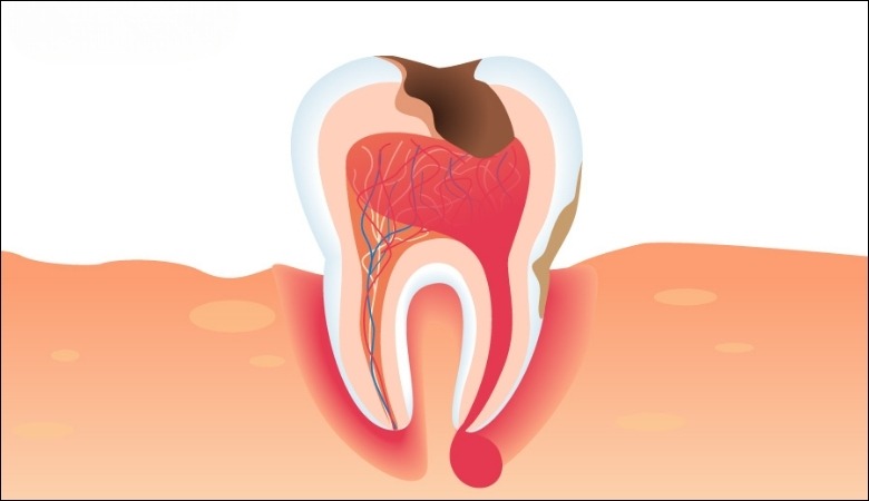 Áp xe răng gây đau nhức và chảy máu nướu