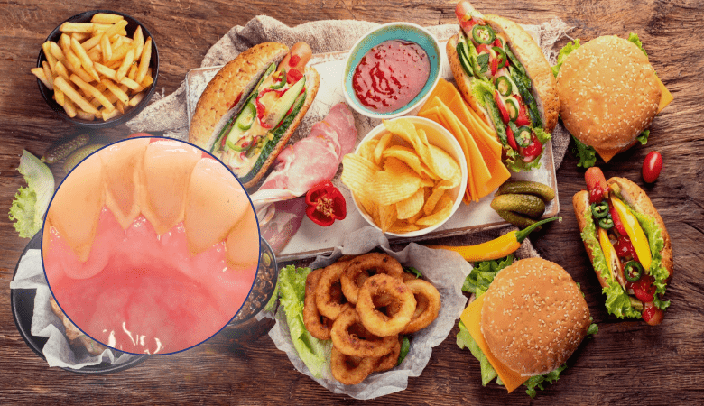 Nguyên nhân gây cao răng