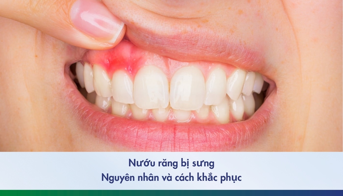 Cách khắc phục nướu răng bị sưng