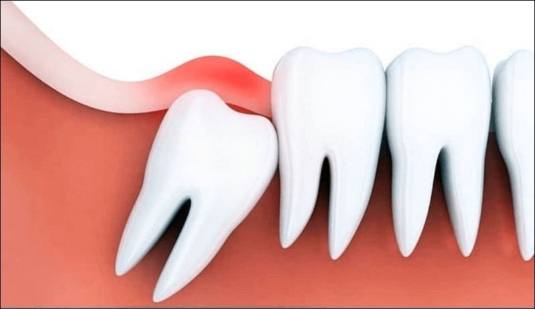 Mọc răng khôn khiến nướu răng bị sưng