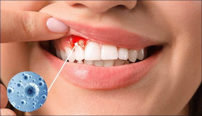 Viêm lợi khiến nướu răng bị sưng