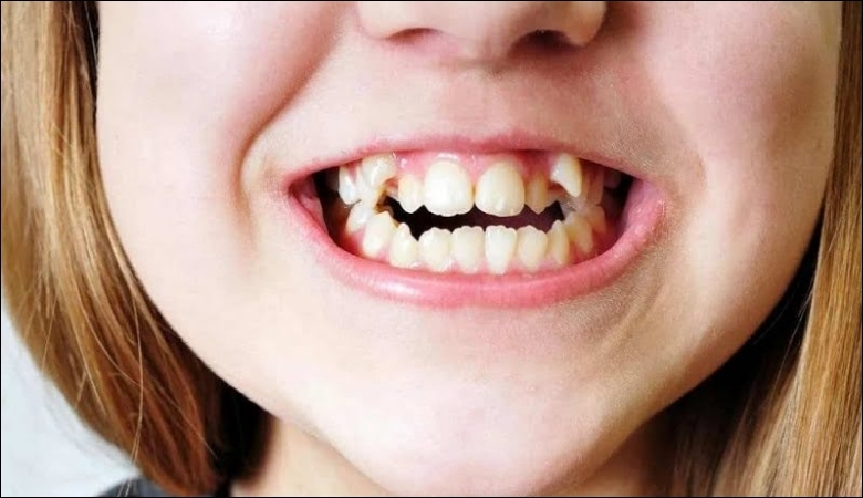 Răng chó mọc lệch có thể ảnh hưởng đến thẩm mỹ khuôn mặt