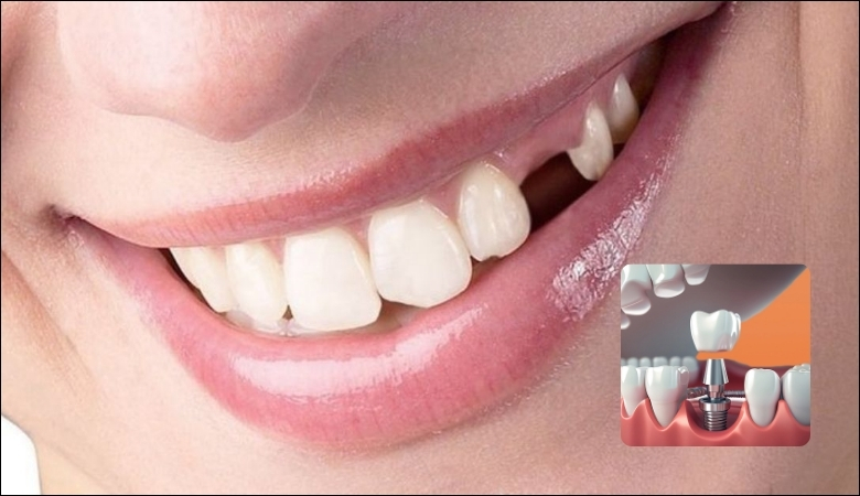 Trồng răng Implant để khắc phục mất răng chó