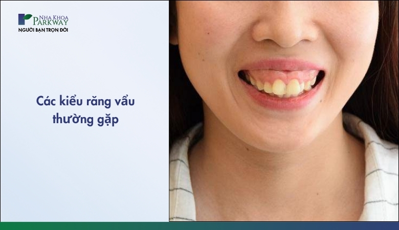 Các kiểu răng vẩu thường gặp