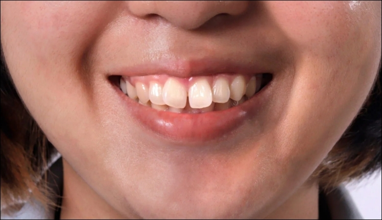 Răng vẩu là một dạng sai lệch khớp cắn