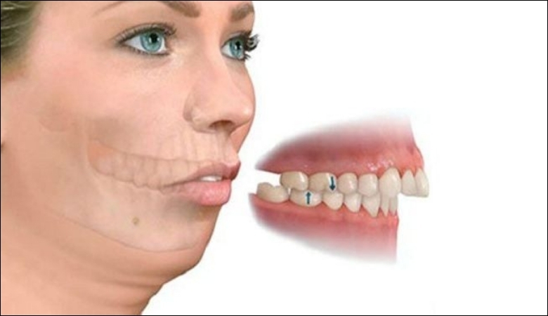 Cấu trúc hàm chìa ra ngoài nhiều sẽ gây răng vẩu hàm