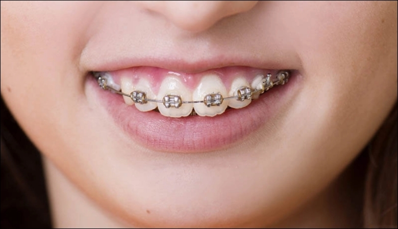 Niềng răng vẩu hiệu quả với trường hợp răng hàm mọc lệch