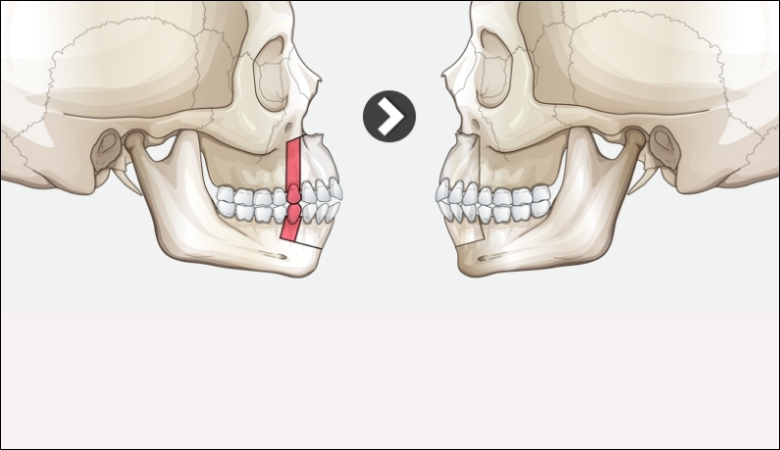 Phẫu thuật xương hàm giúp khắc phục răng vẩu do hàm