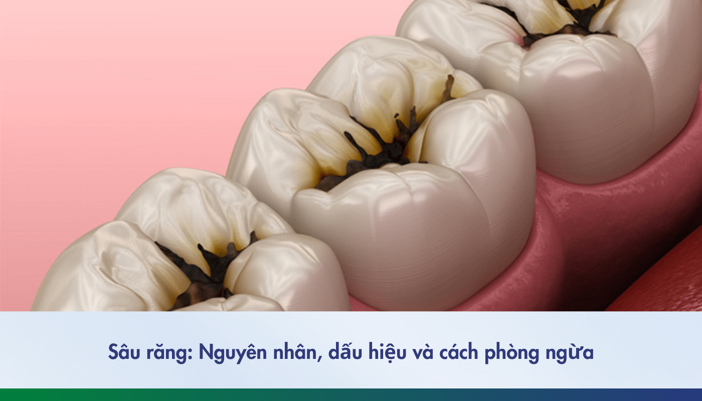 nguyên nhân, dấu hiệu và cách phòng ngừa sâu răng