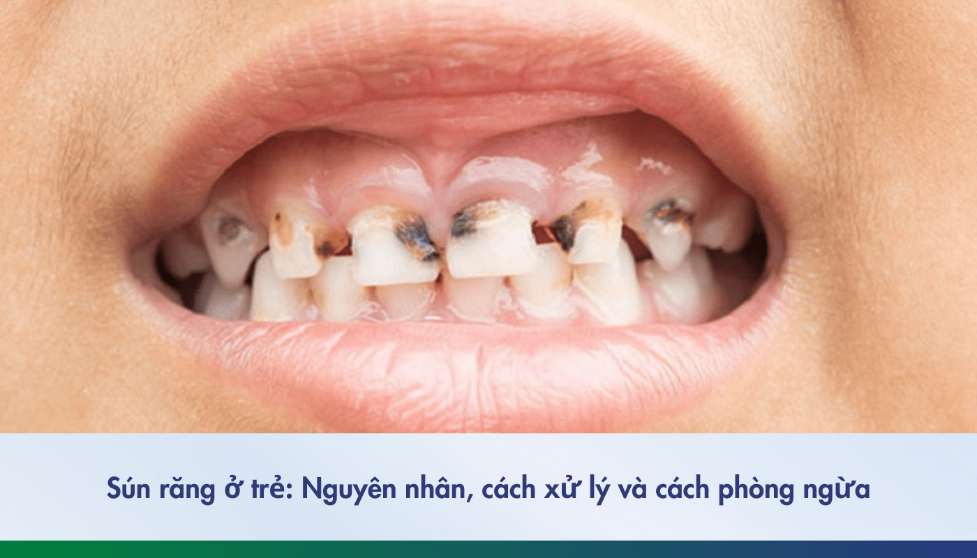 sún răng ở trẻ, nguyên nhân và cách xử lý
