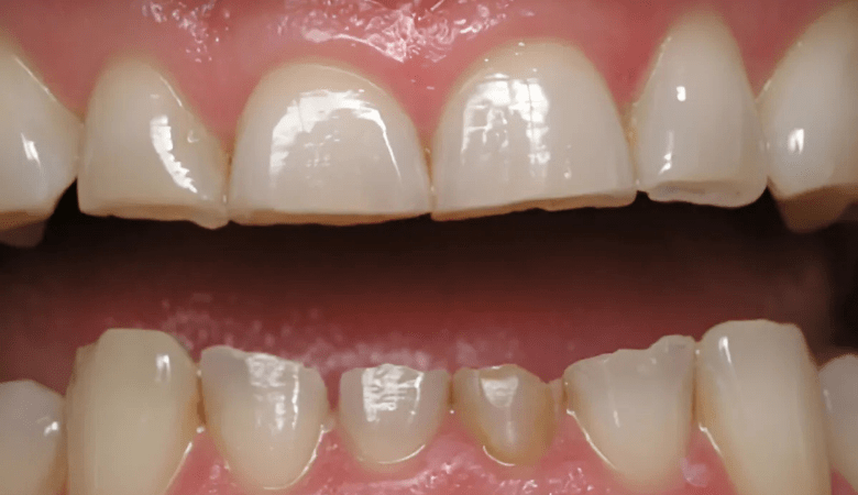 Tác hại của nghiến răng