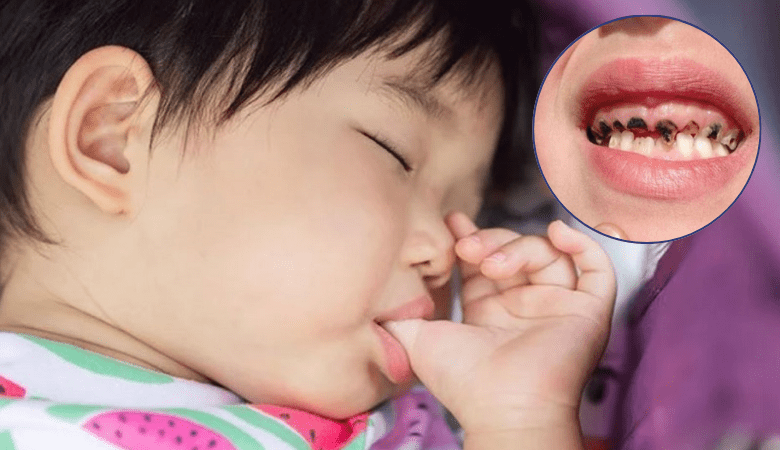 Thói quen xấu ảnh hưởng sún răng