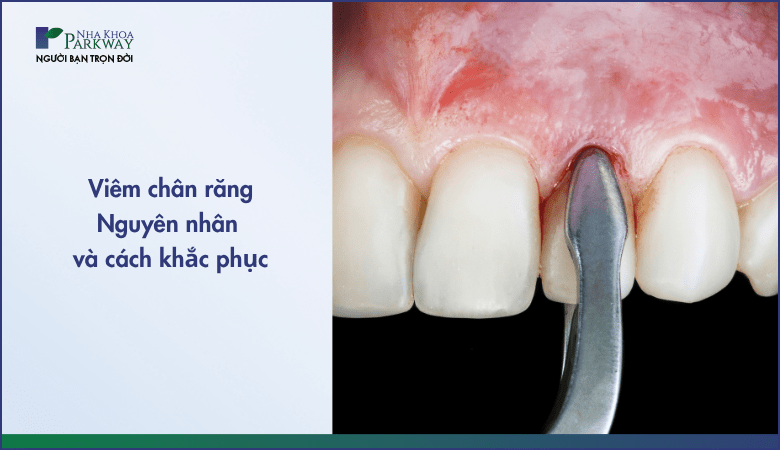 Viêm chân răng và cách khắc phục