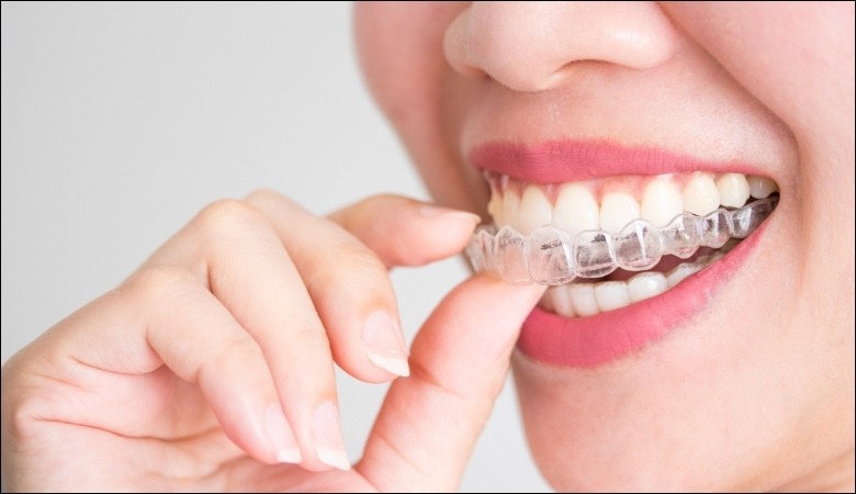 Invisalign sử dụng các khay niềng trong suốt được thiết kế riêng biệt cho từng bệnh nhân