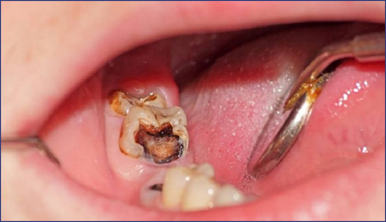 cách điều trị nhức răng có lỗ