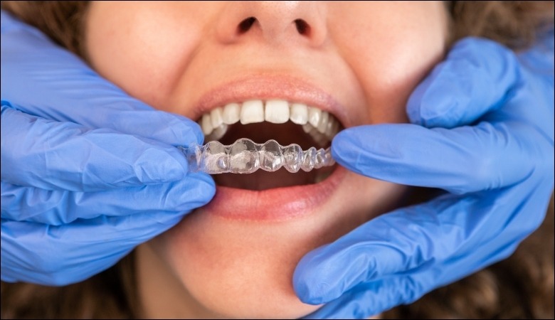 Kinh nghiệm và trình độ của bác sĩ có vai trò quan trọng đối với quá trình niềng răng invisalign