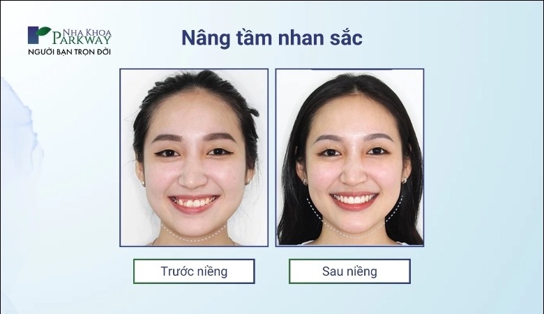 Hình ảnh trước và sau khi niềng răng Invisalign tại Nha khoa Parkway