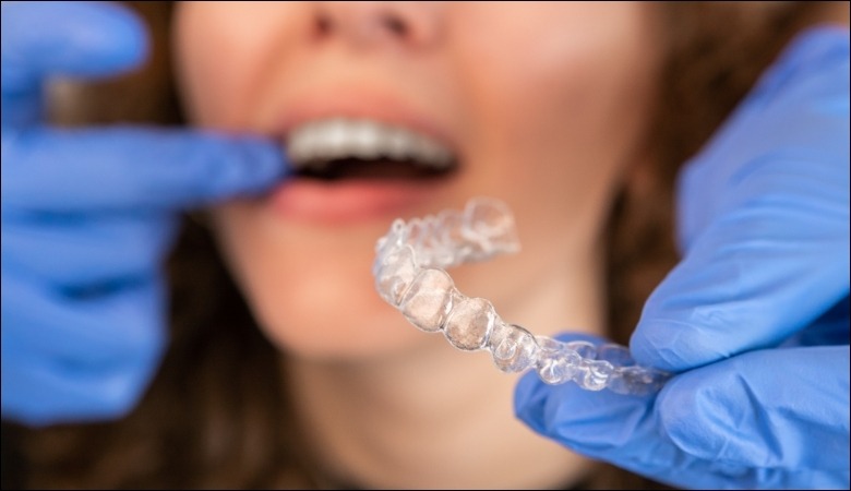 Invisalign là hệ thống chỉnh nha sử dụng các khay niềng trong suốt được thiết kế riêng biệt cho từng bệnh nhân