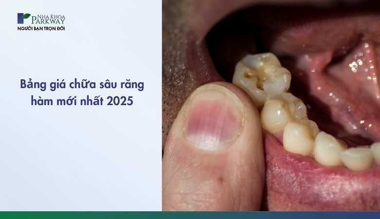 Chữa sâu răng hàm giá bao nhiêu