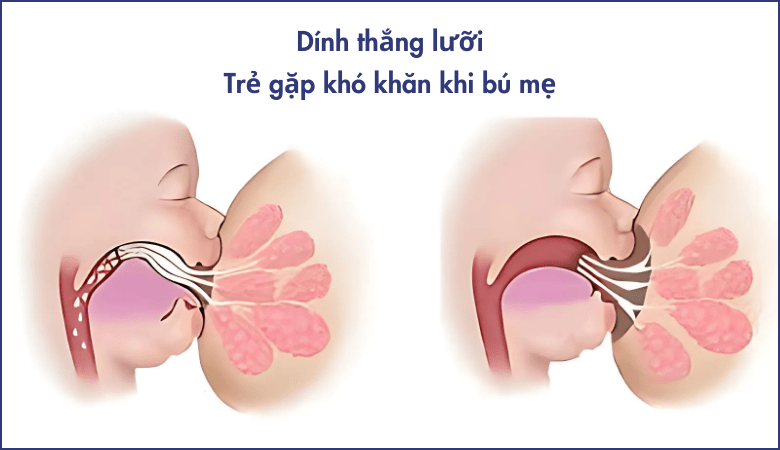 Dấu hiệu dính thắng lưỡi