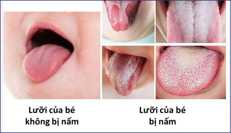 Hình ảnh nấm lưỡi ở trẻ em